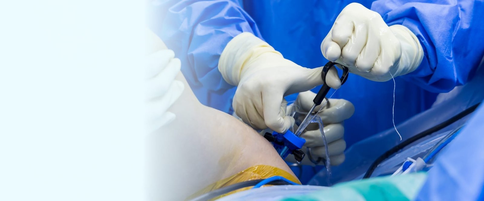 FAQ arthroscopie de l'épaule