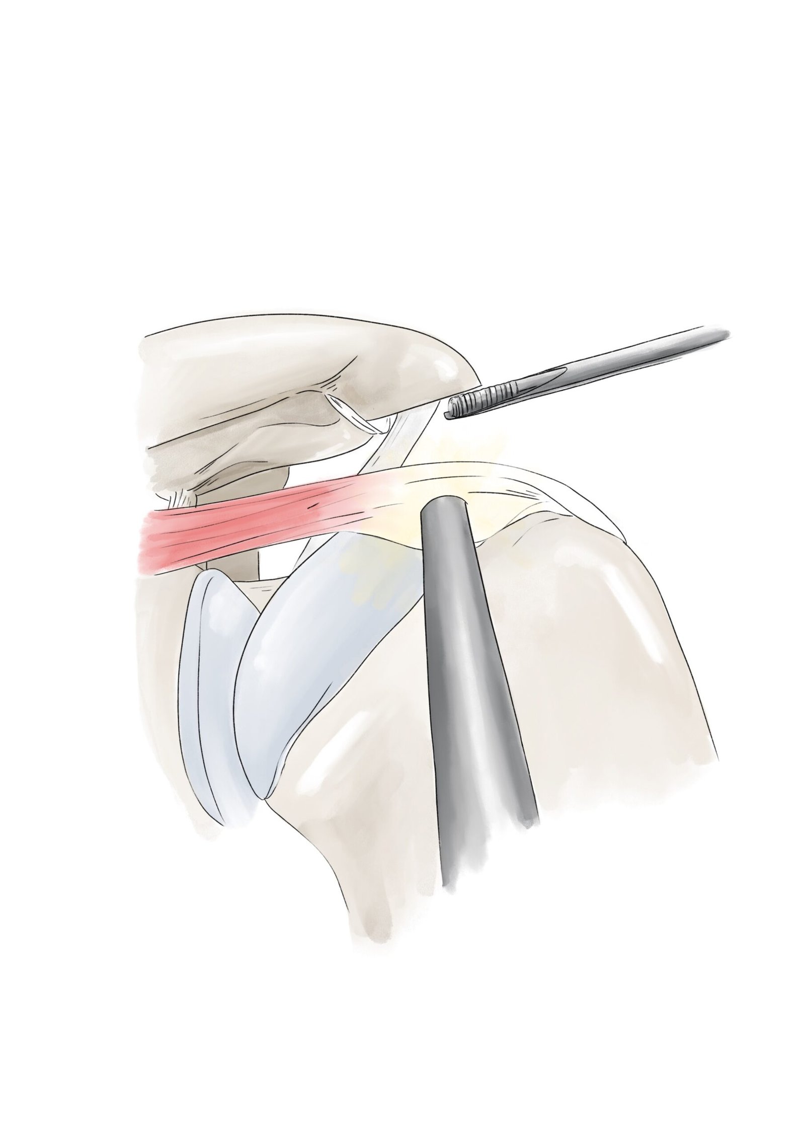 Acromioplastie
