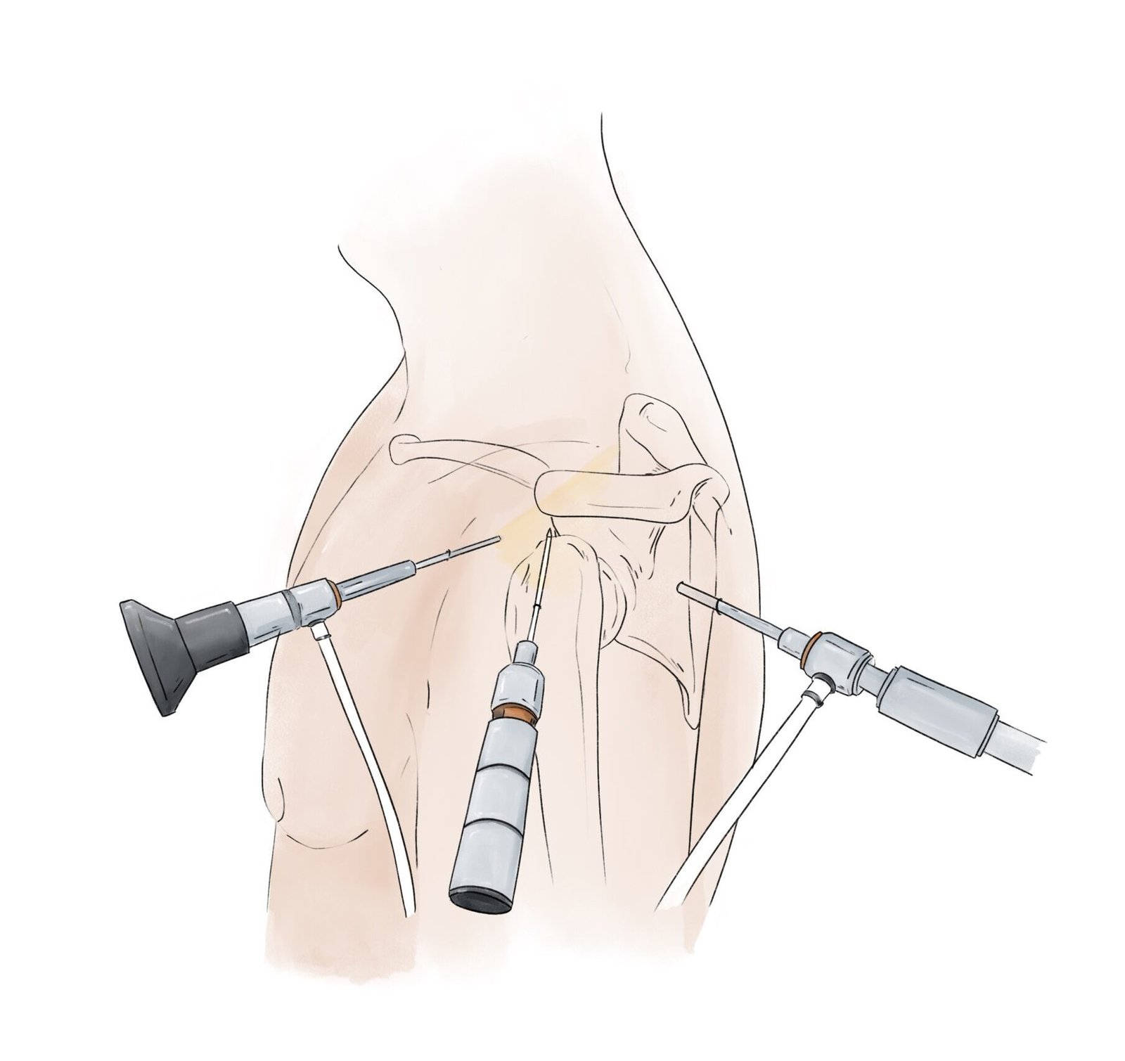 Vue arthroscopique de l'articulation de l'épaule