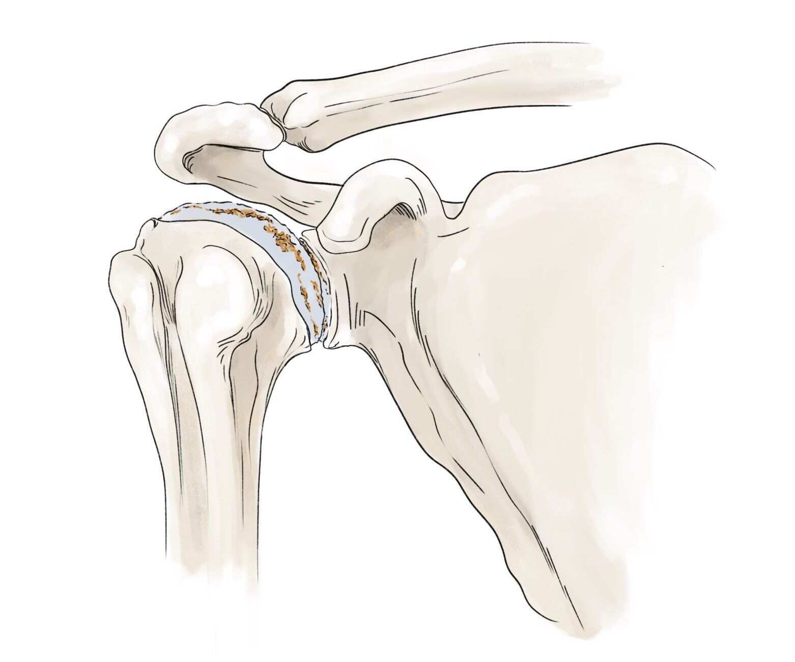 Omarthrose : arthrose au niveau de l'épaule, avec usure du cartilage recouvrant l'os.