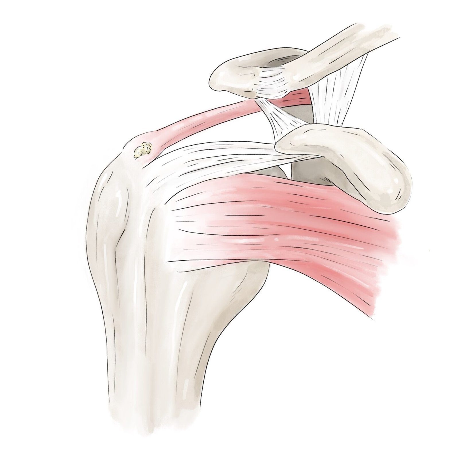 Calcification tendineuse de la coiffe des rotateurs