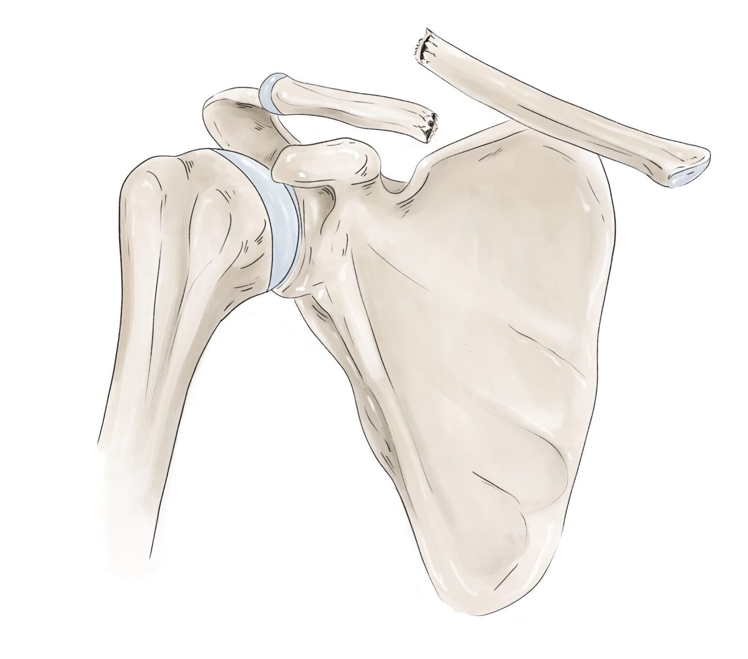 Fracture de la clavicule — schéma 1