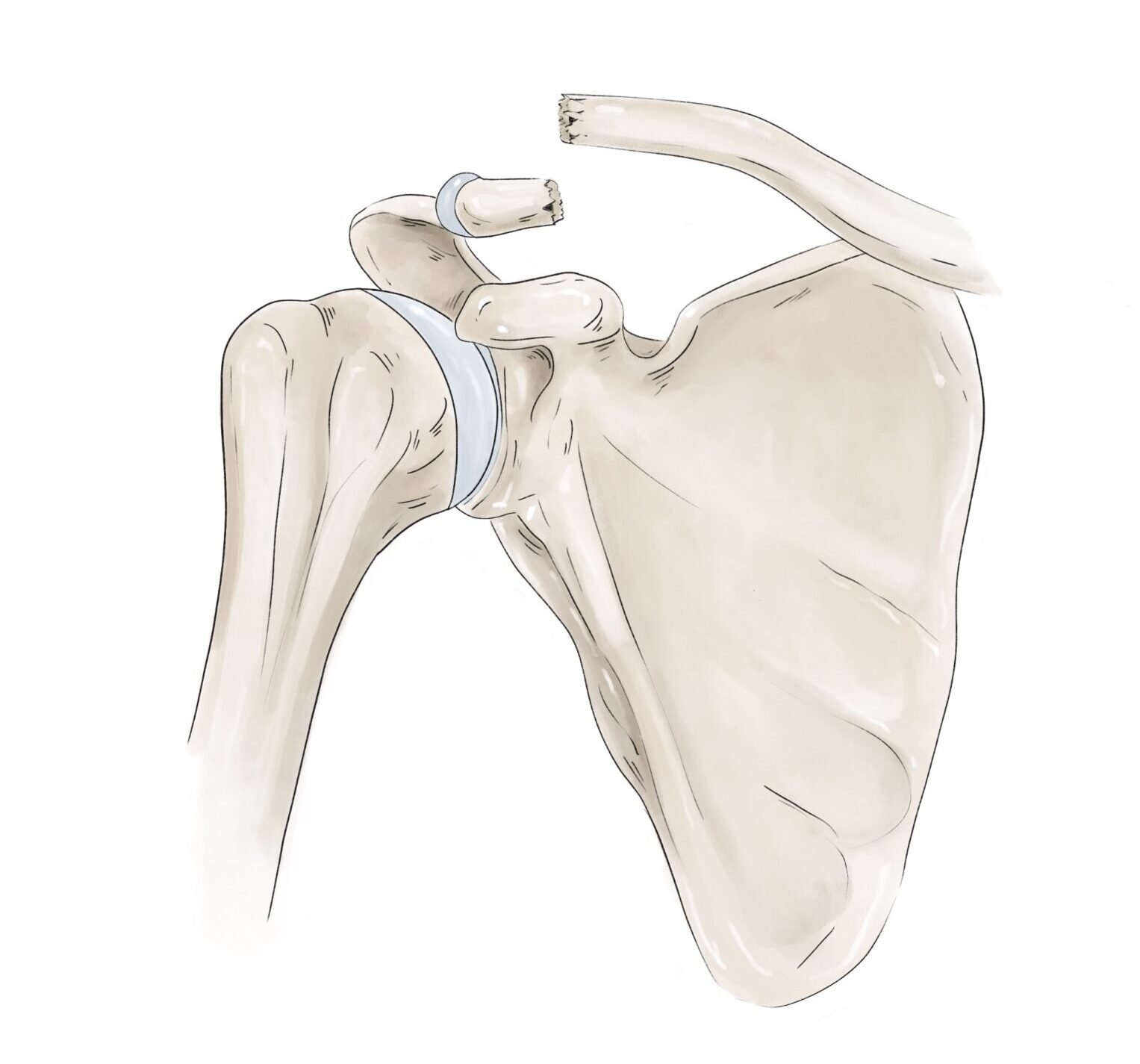 Fracture de la clavicule — schéma 2