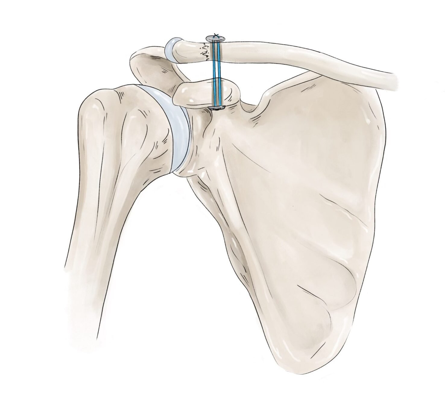 Clavicule reconstruite