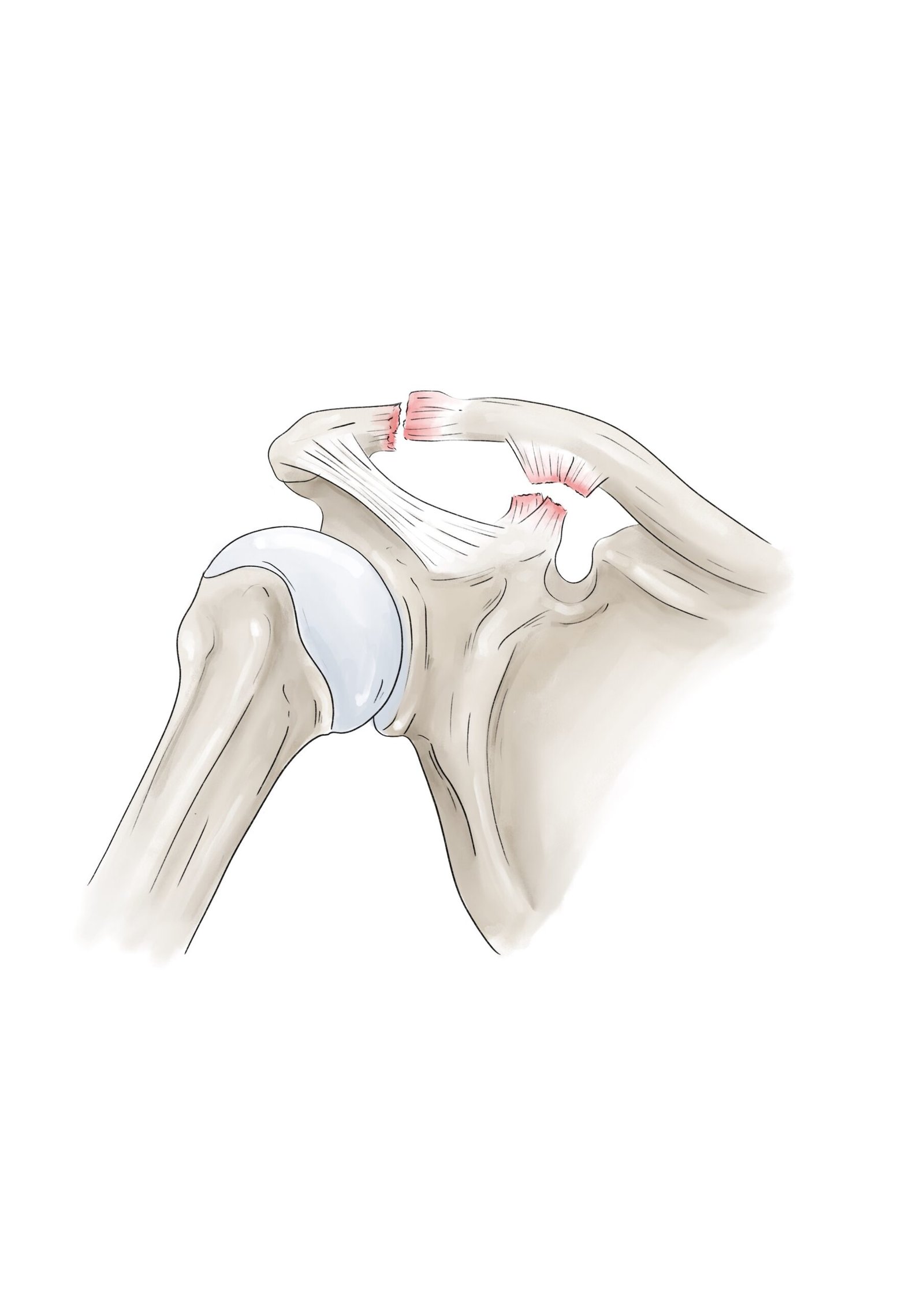 Schéma d'une disjonction acromio-claviculaire