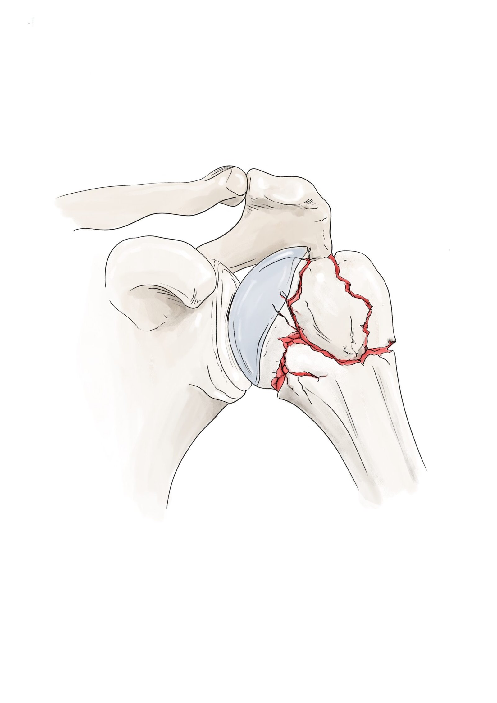 Fracture de l'humérus