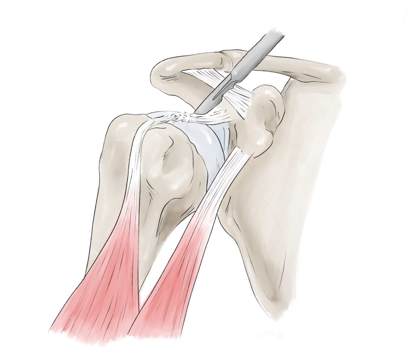 ténodèse biceps étape 1