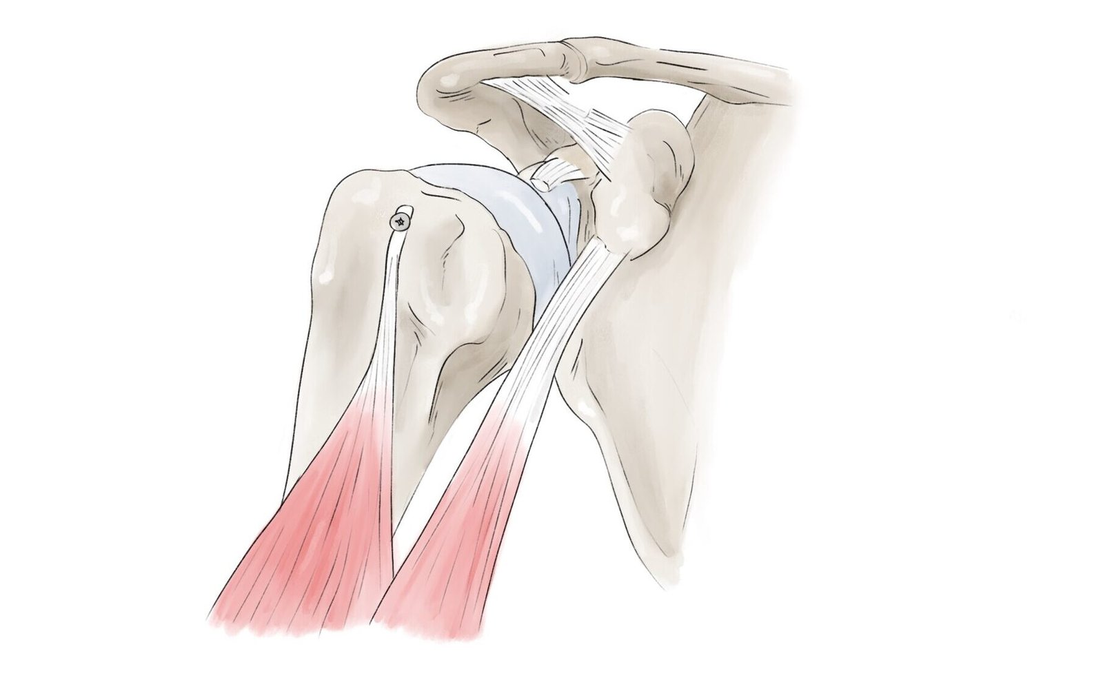 Ténodèse biceps étape 2