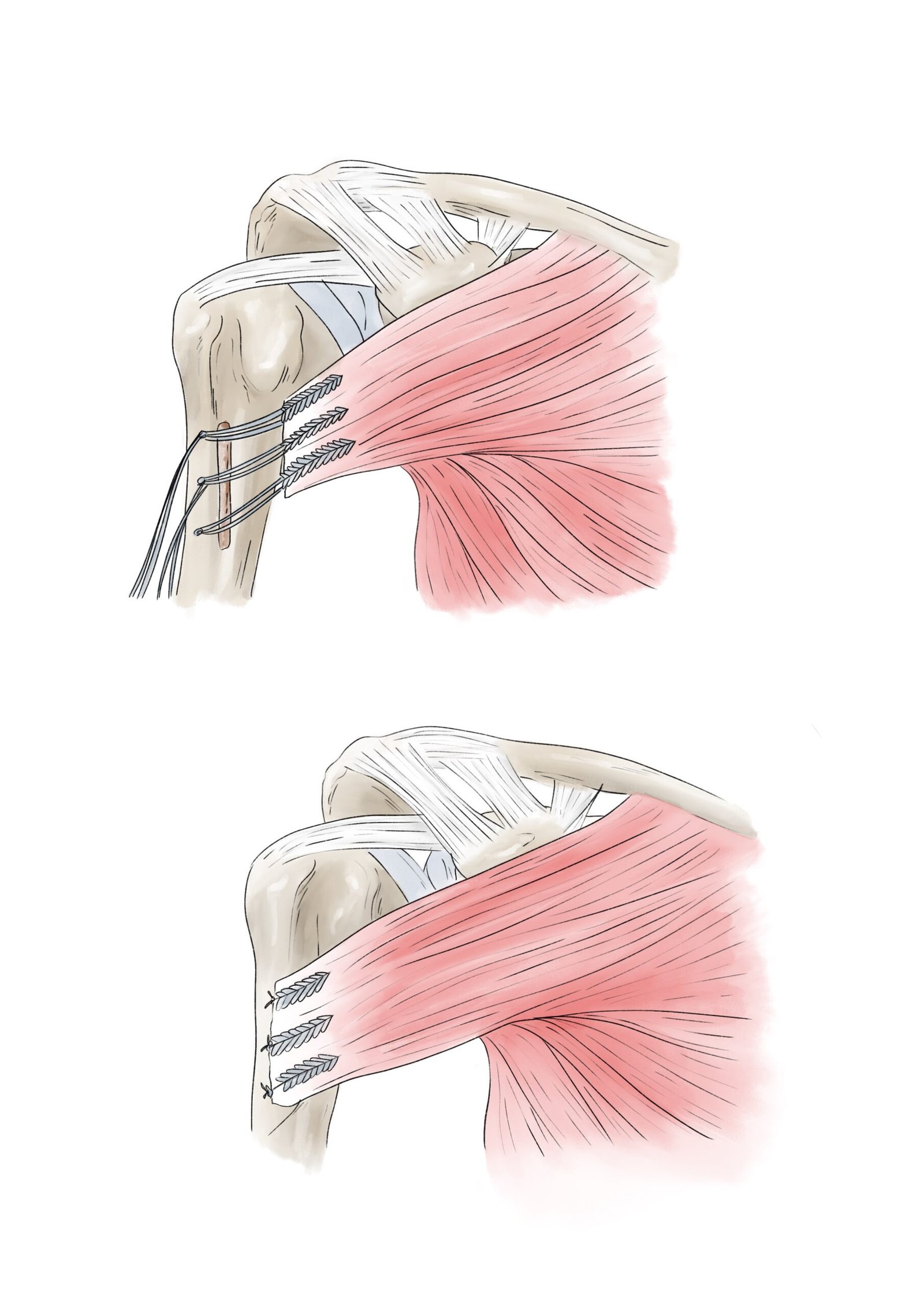 Réinsertion du grand pectoral sur l'humérus