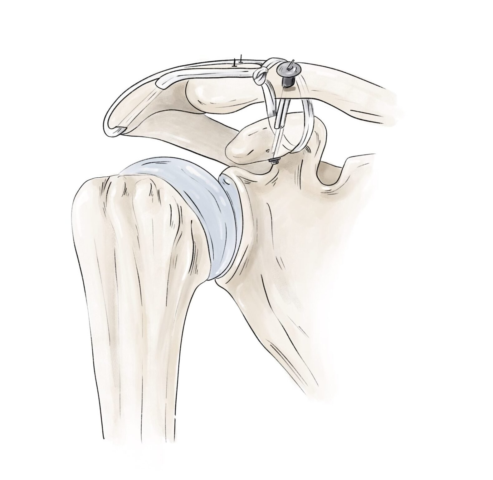 Reconstruction ligamentaire par greffon tendineux
