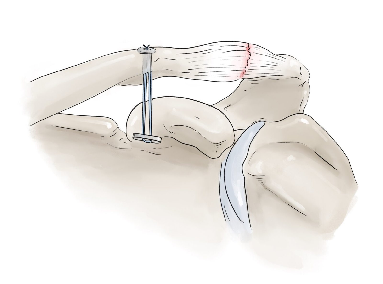 Stabilisation par endo-bouton à travers la clavicule