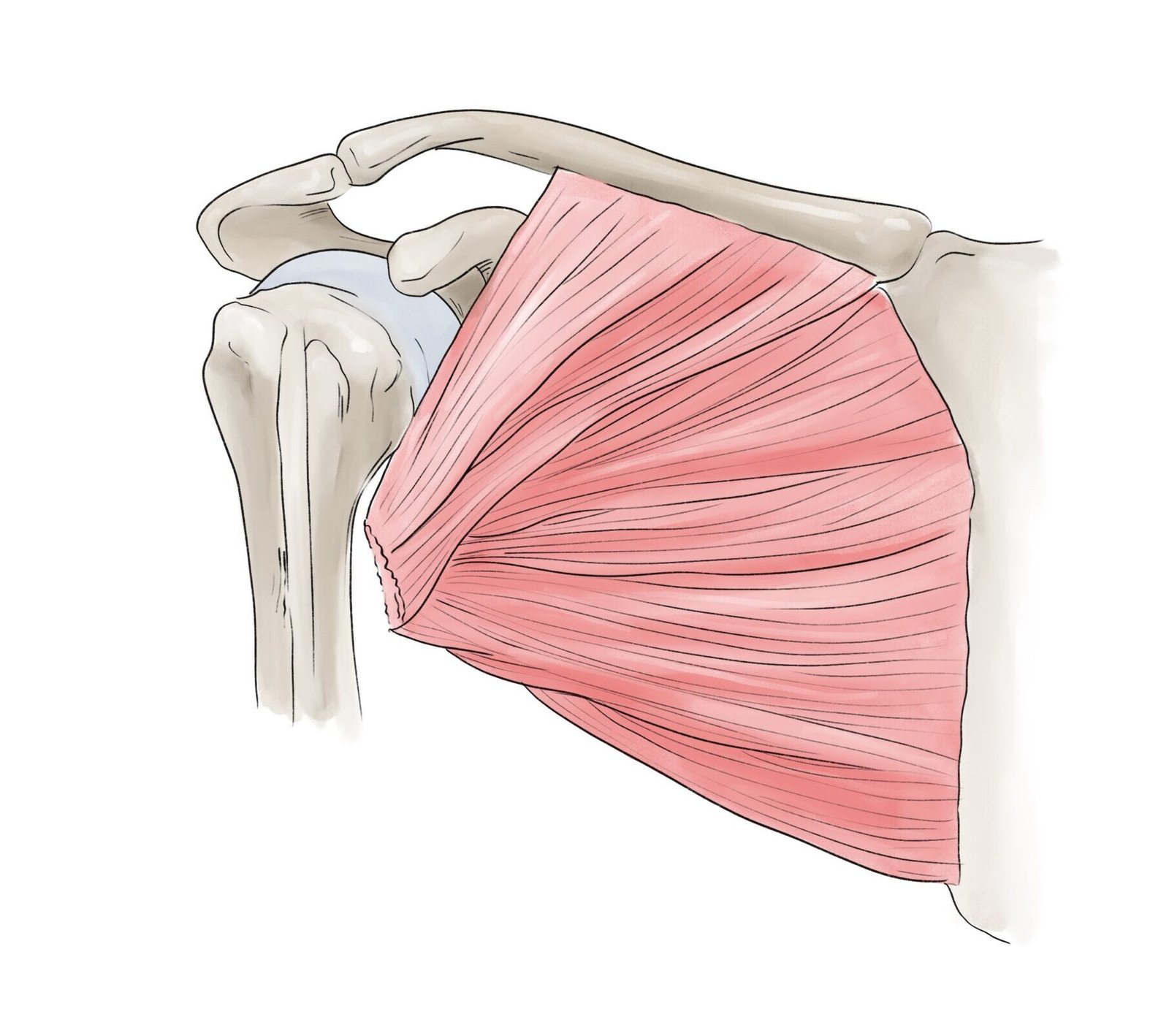 Illustration d'une rupture du grand pectoral